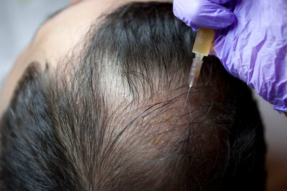 About Platelet Rich Plasma (PRP) Hair Treatment