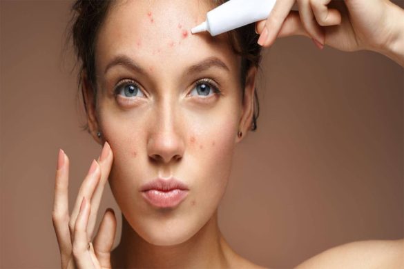 Treatment For Acne Problem